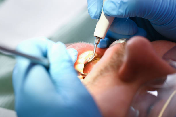 Best Emergency Dentist for Knocked-Out Tooth in Fremont, MI